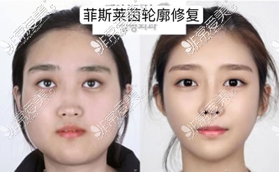 韩国菲斯莱茵整形外科面部轮廓修复手术好不好含价格特色
