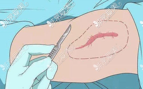 深圳南雅医疗美容手术除疤卡通示意图