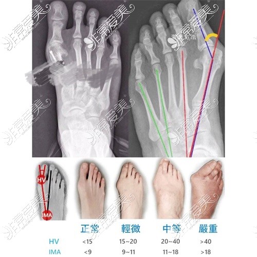 大腳骨不同程度分類