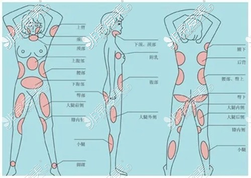 在长沙做抽脂整形一般什么价钱?大腿抽脂来这抽的好还不贵!