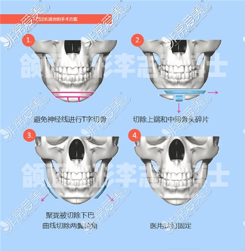 李志海医生下巴整形手术方式