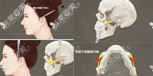 顴骨手術(shù)整體示意圖