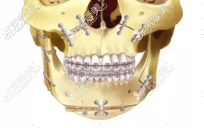 正颌手术固定方式图