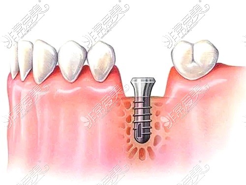 种植牙示意图
