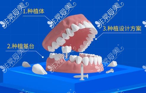 种植牙改善治疗展示图