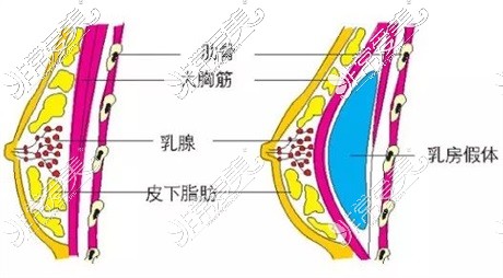 新疆华美黄江泊假体隆胸示意图