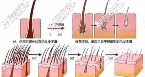 植發(fā)示意圖