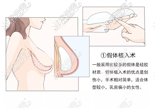 乳房重建手術卡通圖