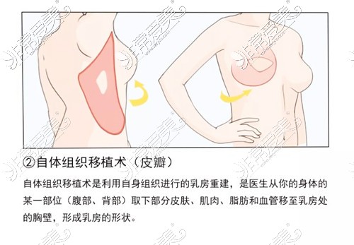 乳房重建手術卡通圖