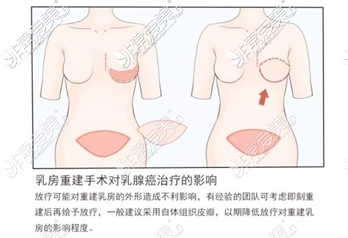 乳房重建手術卡通圖