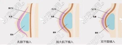 贵阳隆胸选择这几家不后悔,想技术好人气高的隆胸医院看这