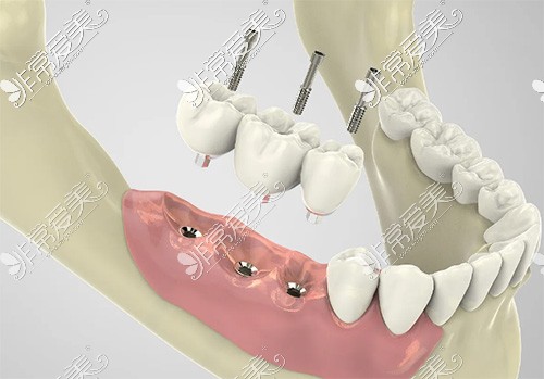 种植牙示意图片
