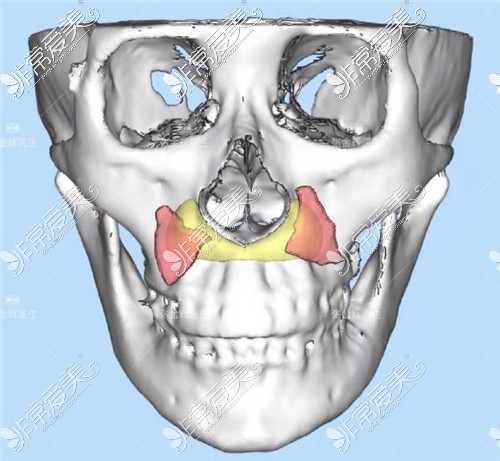3D打印填充鼻基底设计图