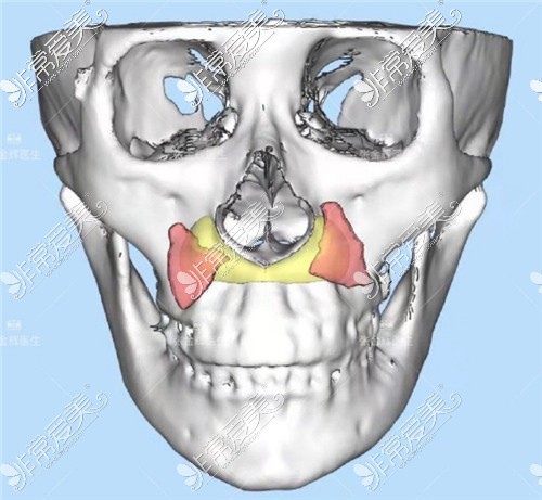 3D打印填充鼻基底設計圖