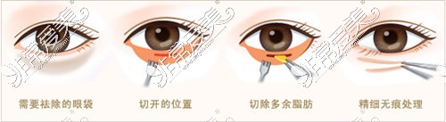 眼袋改善治疗手术展示图
