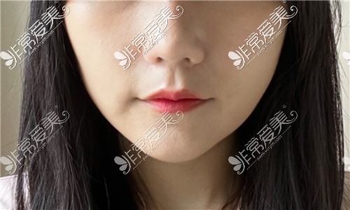 韩国365mc双下巴抽脂日记分享 瓜子脸也不需要做磨骨手术