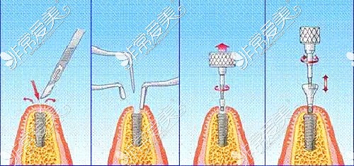 種植牙手術(shù)步驟示意圖