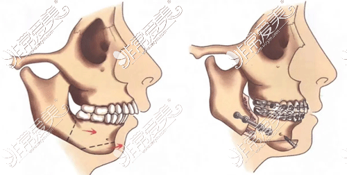 龅牙手术方式图