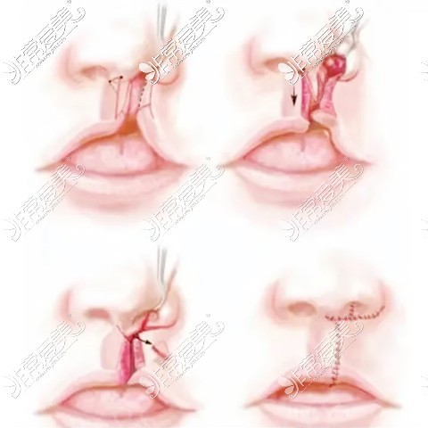 兔唇修复手术前后图示