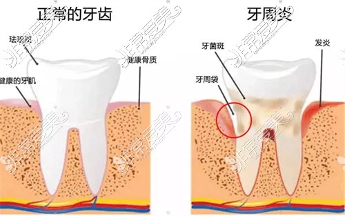 洗牙可以預防牙周炎