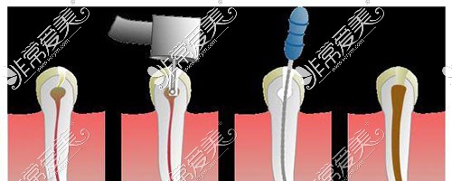 根管治疗示意图