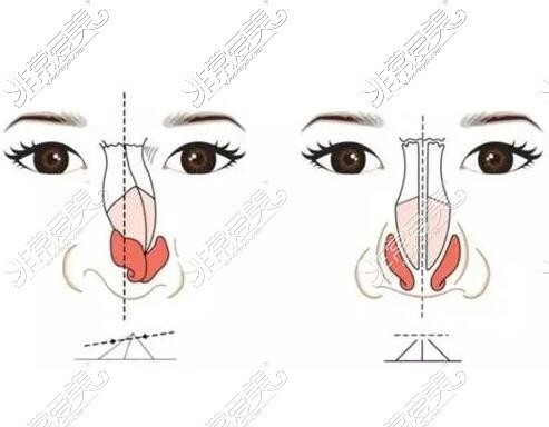 歪鼻做鼻修复改善治疗