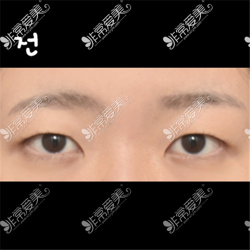 韩国ICON整形医院埋线双眼皮+眼肌矫正术前