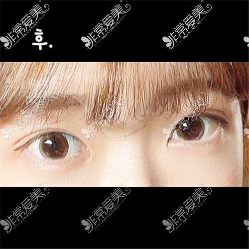 韩国ICON整形医院埋线双眼皮+眼肌矫正术后图