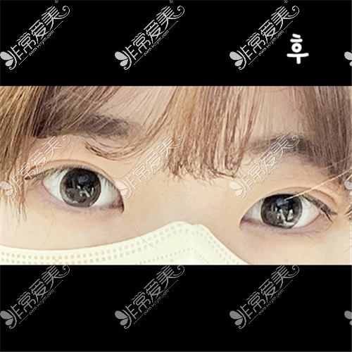 韩国ICON整形医院埋线双眼皮+眼肌矫正术后变化