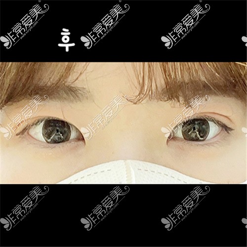 韩国ICON整形医院埋线双眼皮+眼肌矫正术后