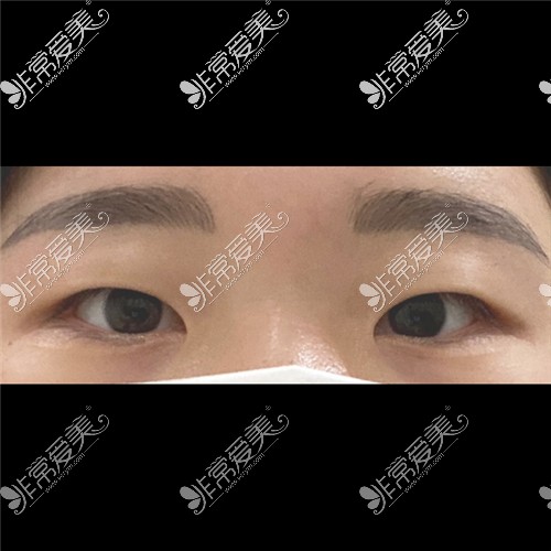 韩国ICON（图标）整形医院双眼皮术前