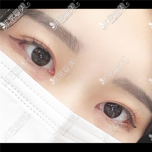 韩国ICON（图标）整形医院双眼皮术后图