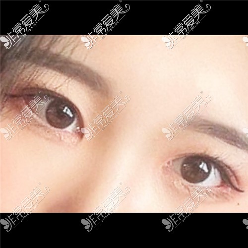 韩国ICON（图标）整形医院双眼皮术后照片