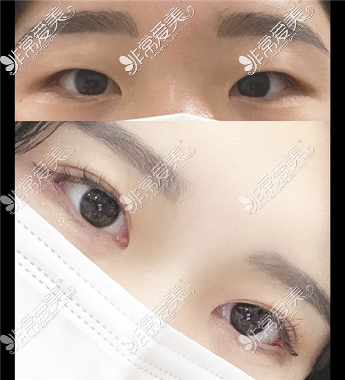 韩国ICON（图标）整形医院双眼皮对比