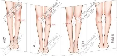 O型腿中医四维矫正可信吗?武汉腿型矫正医院哪家好?上名单