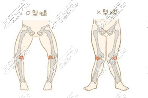 腿型矫正图示