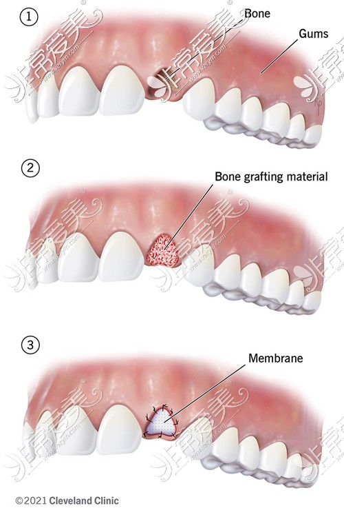 种植牙骨粉填充流程