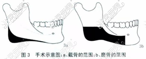 下颌角磨骨范围示意图