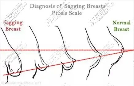 福州胸部下垂矫正哪家医院好?分享三家乳房下垂矫正好医院