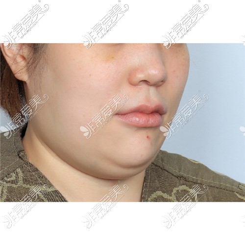 韩国爱乐整形医院做面部吸脂术前照