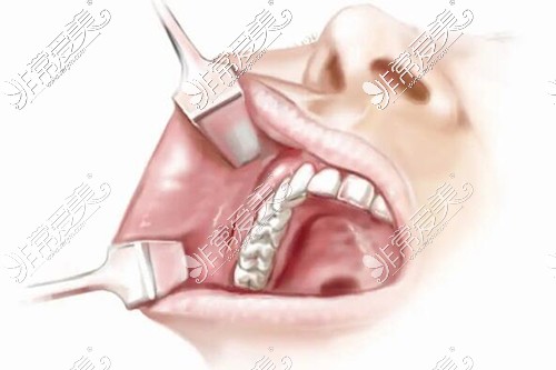 下颌口内切口展示图