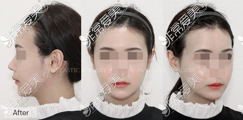 韩国1%整形医院面部轮廓整形疗效展示