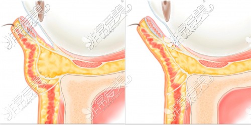 眼底眶隔脂肪释放前后对比
