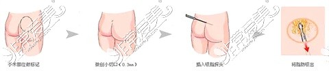 新疆黎美整形医院臀部吸脂示意示意图