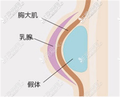 隆胸手术