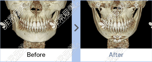 下颌角整形手术前后ct正面图片