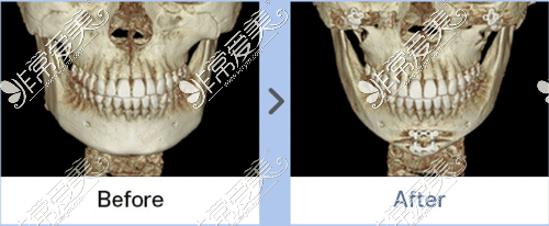 下頜角整形手術(shù)前后ct正面圖片