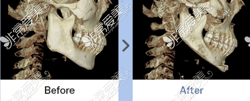 下颌角整形手术前后ct侧面图片