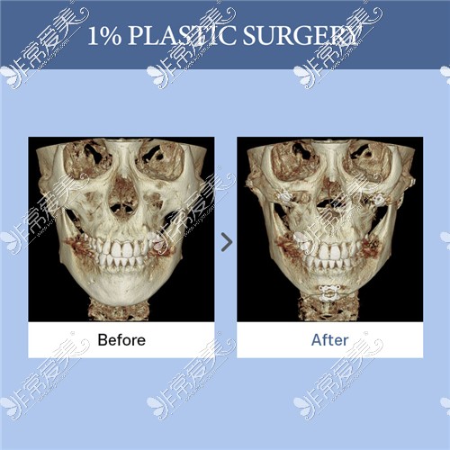 韩国1%整形外科做颧骨颧弓整形+下巴截骨手术的CT图