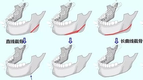 不同的下颌角截骨方式